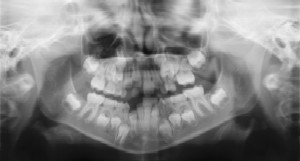 Dental Radiographs (X-Rays) - Pediatric Dentist in Columbus, OH