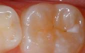 Sealant-Before - Pediatric Dentist in Columbus, OH